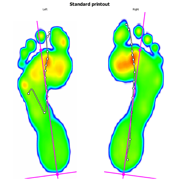 Picture of barefoot running, with strong red hotspots under the ball of the feet.